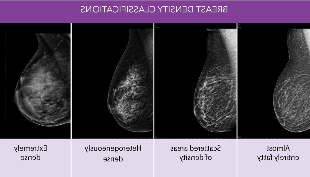 乳腺密度分类:几乎全是脂肪, 分散的密度区域, 混合密度, 密度极高